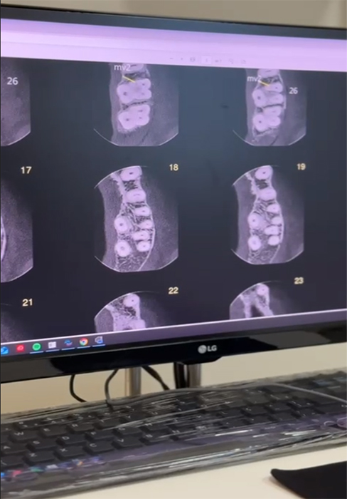 Tomografia na Endodontia - Imagem 2